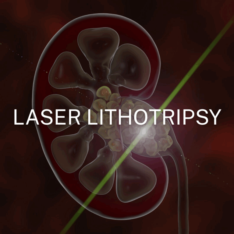 Flexx Track Connector application for laser lithotripsy