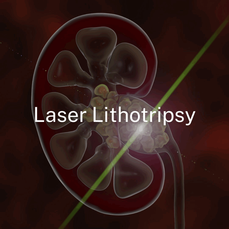 Laser Lithotripsy application of Dome Tip Fibers