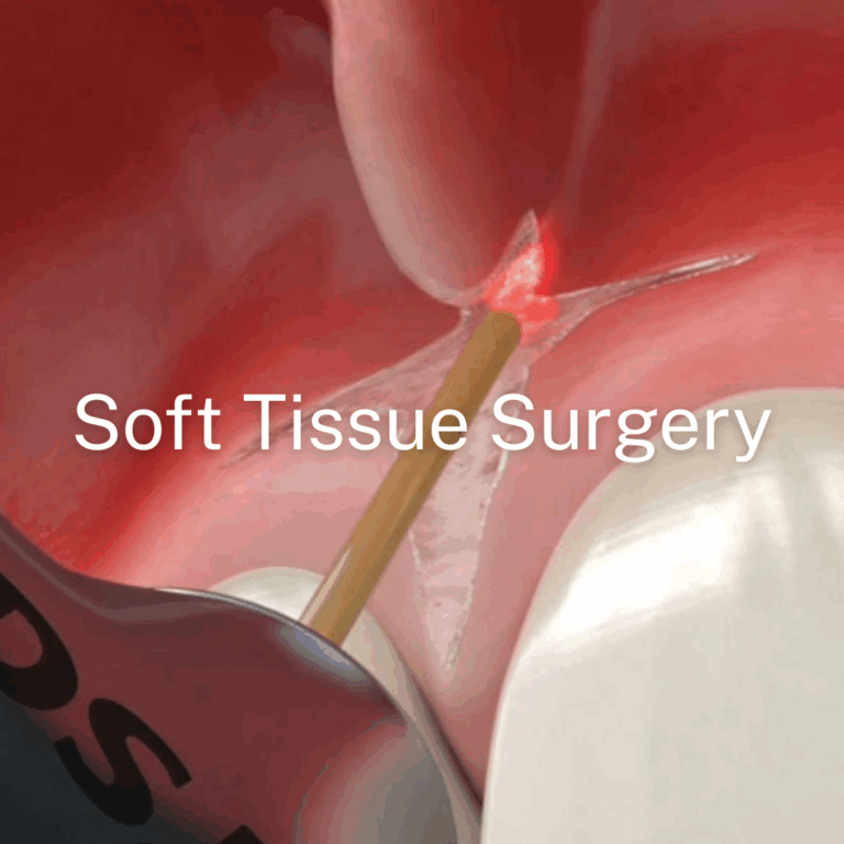 Medical Laser Fiber for Soft Tissue Surgery