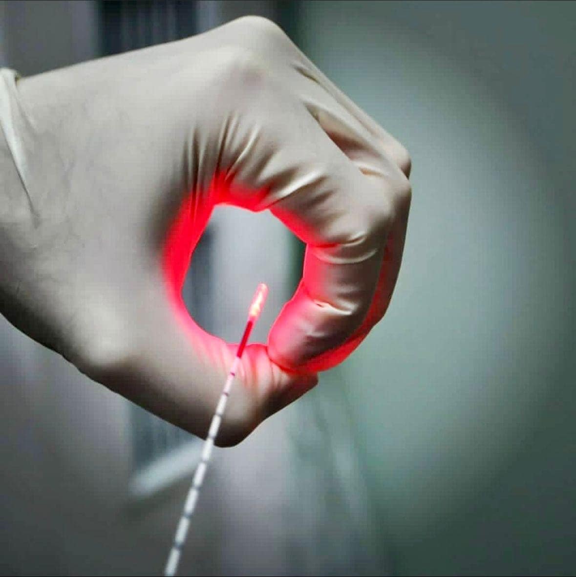 Radial Tip Laser Fiber