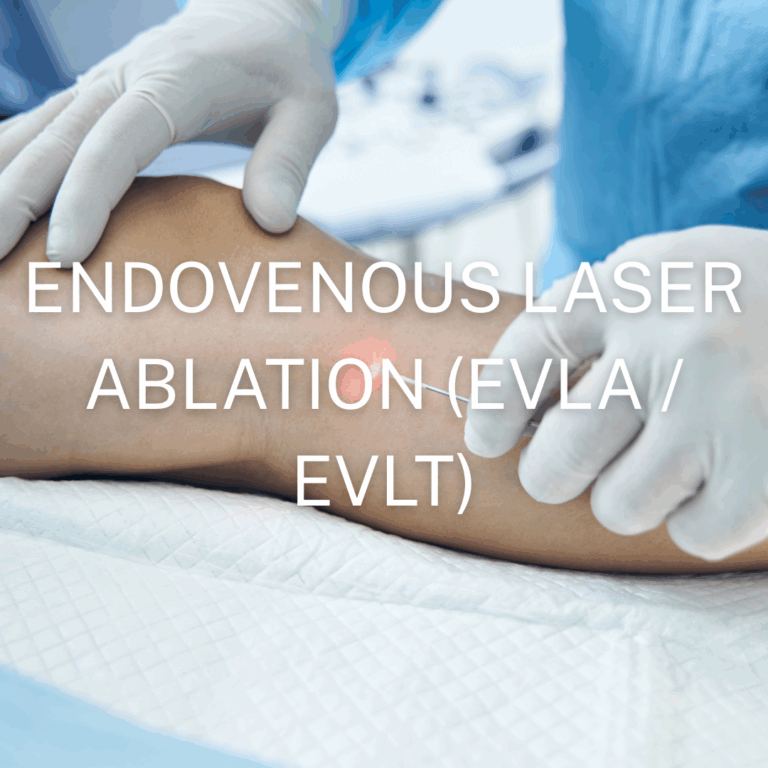 Endovenous Laser Ablation application